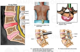 Lumbar Spine Injury with Surgical Discectomy and Fusion