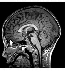 Normal MRI Showing Sagittal View of the Head