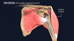 Reverse Shoulder Replacement with Deltoid Muscle Highlighted