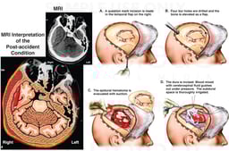 Brain Injury Repairs