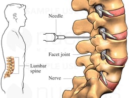 Facet Joint Nerve Block