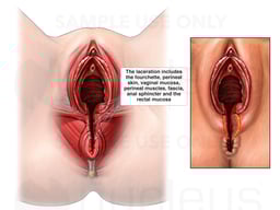 Fourth Degree Perineal Laceration