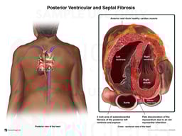 Posterior Ventricular and Septal Fibrosis