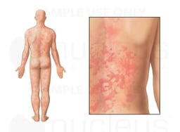 Urticarial Plaque-type Hives