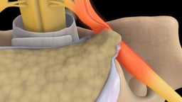 Cervical Disc Herniation