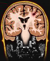 Brain with Cerebrum Trauma (MRI), Anterior Cut-away View