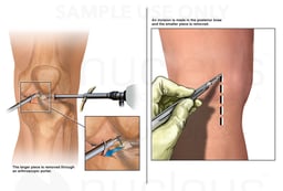 Surgeries to Remove Pieces of Retained Scalpel Blade from Left Knee Joint