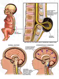 Congenital Birth Defects - Spina Bifida, Hydrocephalus and Arnold-Chiari Malformation