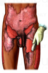 Severe Burn Debridement