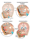Progression of Meningitis Following Cranial CSF Leak