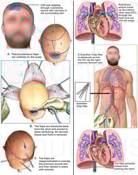 CSF Leak with Primary Reapir, Scalp Reconstruction and Subsequent Pulmonary Emboli