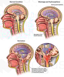 Progression of Hydrocephalus with Eventual Herniation of the Brain Stem