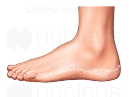 Athlete's Foot: Moccasin-type