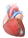 Heart and Coronary Arteries with Infarct of the Proximal LAD