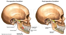 Surgical Removal of Impacted Molar with Subsequent Nerve Damage