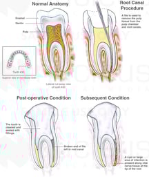 Root Canal Procedure with Broken File and Subsequent Abscess