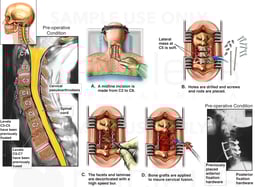Cervical Spine Injuries with Double Level Discectomy and Fusion