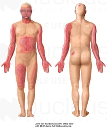 Front and Back Male Figures with Post-accident Burn Injuries