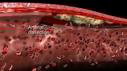 Cerebral Artery Dissection and Stroke