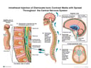 Intrathecal Injection of Diatrizoate Ionic Contrast Media with Spread Throughout the Central Nervous System