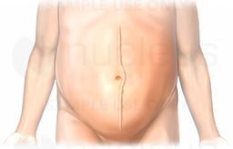 Abdominal Incision Scar