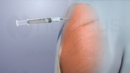 Treatment and Prevention of Syphilis