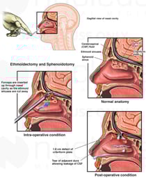 Endoscopic Sinus Surgery with Resulting Damage