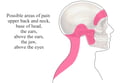 Tension Headache: Areas of Pain