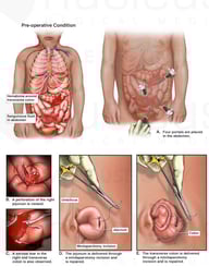 Perforated Bowel with Exploratory Laparoscopy and Repair