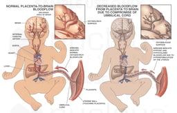 Hypovolemic and Hypoxic Ischemic Encephalopathy (Brain Damage)