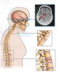 Brain and Spine Injuries