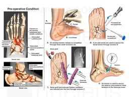 Left Ankle and Foot Injuries with Surgery