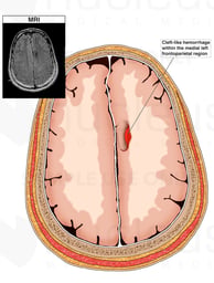 Intracranial Hemorrhage