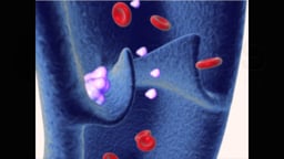 Blood Clot (Embolus) Formation