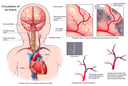 Multiple Air Emboli with Blockage of Blood Supply to an Infants Brain