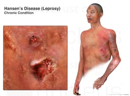 Hansen's Disease: Leprosy Chronic Condition