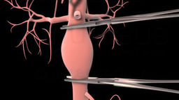 Abdominal Aortic Aneurysm