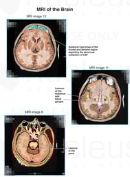 MRI of the Brain