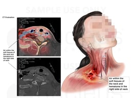 Traumatic Injuries to the Soft tissues of the Neck