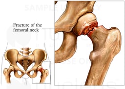 Hip Fracture, femoral neck fracture