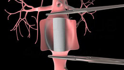 Open Abdominal Aortic Aneurysm Repair: Graft Placement