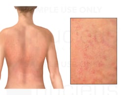 Pityriasis Rosea