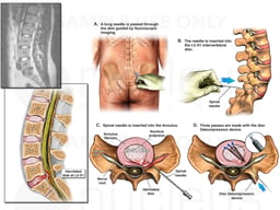 Lumbar Spine Injury with Surgery