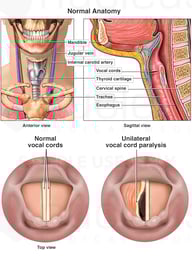 Post-Operative Vocal Cord Paralysis