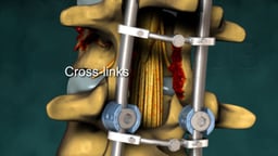 Posterior Spinal Fusion