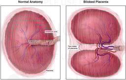 Bilobed Placenta