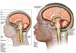 Traumatic Brain Injury