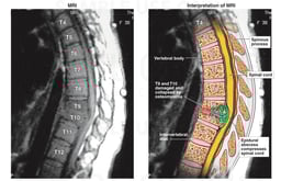Spinal Cord Compression - T9-10 Epidural Abscess.