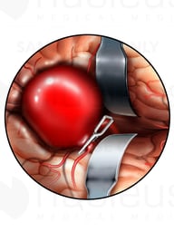 Clamp Cerebral Aneurysm