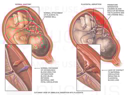 Placental Abruption with Interruption of Fetal Circulation